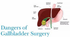 Laparoscopic Cholecystectomy lecture by Dr R K Mishra