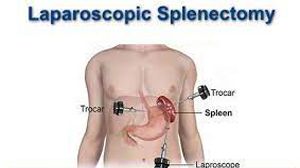 Laparoscopic Hysterectomy with Ureteral Stent Placement