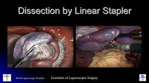 Laparoscopic Appendectomy Surgery Video