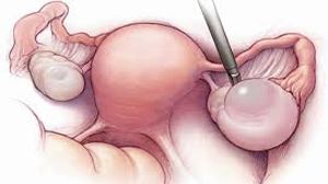 Laparoscopic Hysterectomy with Ureteral Stent Placement for Optimal Patient Care