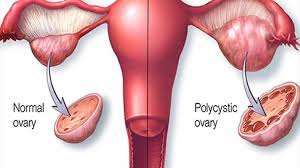 Robotic Cholecystectomy by Dr. R.K. Mishra