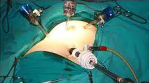 Laparoscopic Ovarian Cystectomy for Large Ovarian Cyst