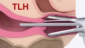 Total Laparoscopic Hysterectomy With U Kit