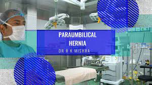 Totally Extra Peritoneal Laparoscopic Hernia Surgery TEP