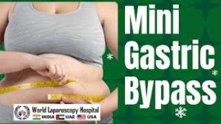 Mini Gastric Bypass for Morbid Obesity