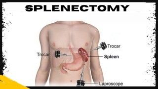 Para-umbilical Hernia IPOM Repair