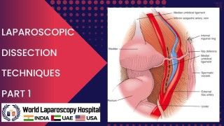 Laparoscopic Myomectomy for Large Myoma by Dr. R.K. Mishra