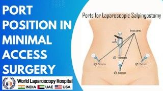 Optimizing Port Position in Minimal Access Surgery: Strategies and Techniques for Improved Outcomes