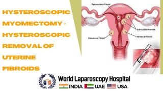 Minimally Invasive Fibroid Removal: Hysteroscopic Myomectomy