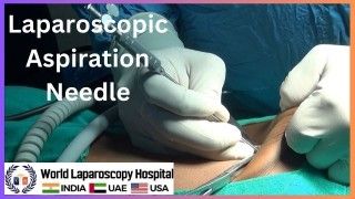 Laparoscopic Management of CBD Stone