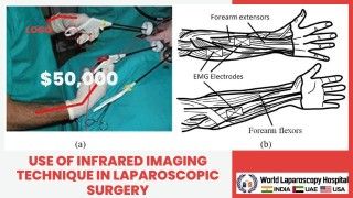 Visualize the Unseen: How Infrared Imaging Enhances Laparoscopic Surgery