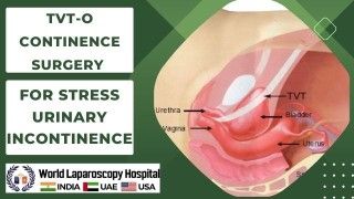 A Solution for Stress Urinary Incontinence: Understanding TVT-O Continence Surgery