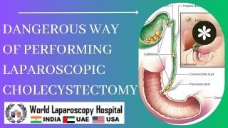 Laparoscopic Varicocelectomy: Minimally Invasive Treatment for Varicoceles