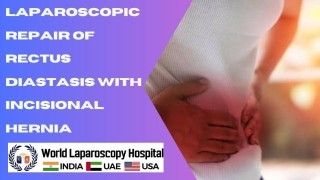 Laparoscopic Repair: Restoring Abdominal Wall Integrity in Rectus Diastasis with Incisional Hernia