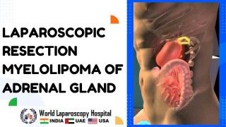 Laparoscopic Surgery For Large Broad Ligament Fibroid