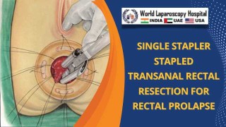 Laparoscopic management of Rectal Cancer