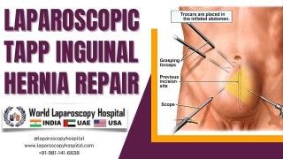 Laparoscopic TAPP Inguinal Hernia Repair: The Efficacy of Ipsilateral Port Placement