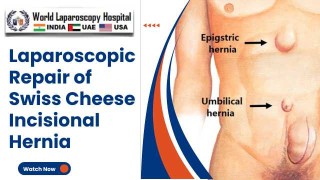 Minimally Invasive Approach to Swiss Cheese Incisional Hernia Repair: A Laparoscopic Solution