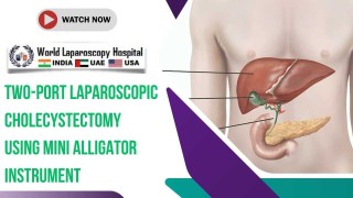 Innovative Two-Port Laparoscopic Cholecystectomy with Mini Alligator Instrument